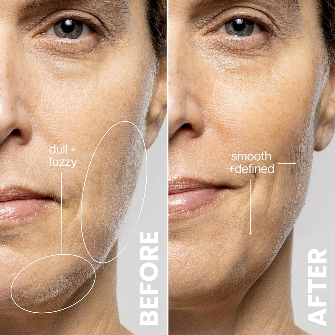 여드름 및 검버섯 제거 액세서리