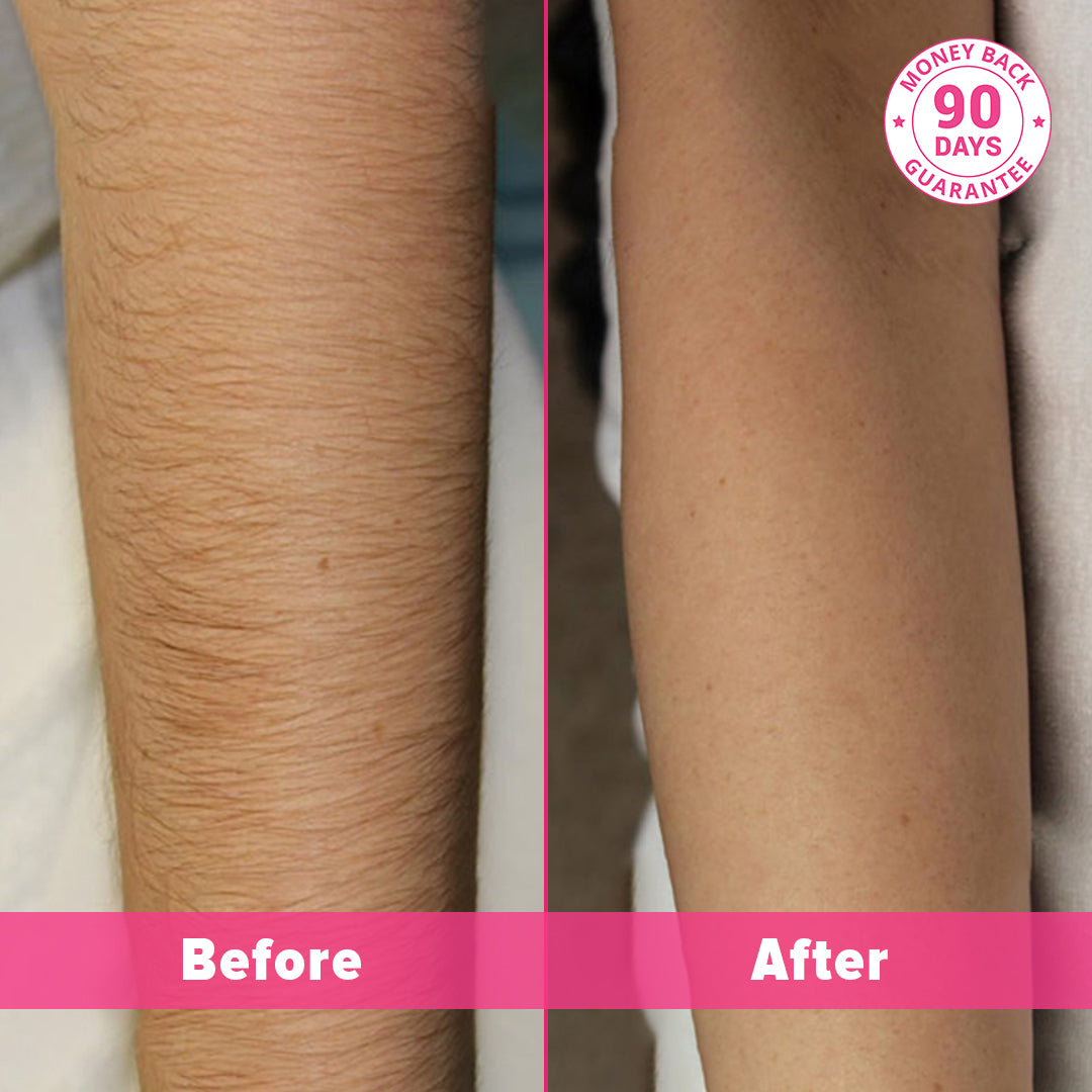 PAIN FRITT-HJEMME-LASER HÅRFJERNING-HÅNDSETT