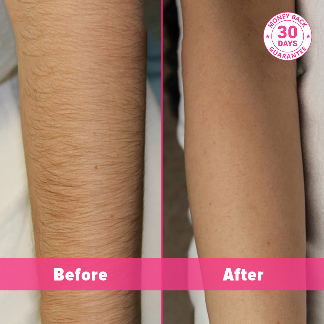 5MINSKIN AT-HOME LASER HAARVERWIJDERING HANDSET