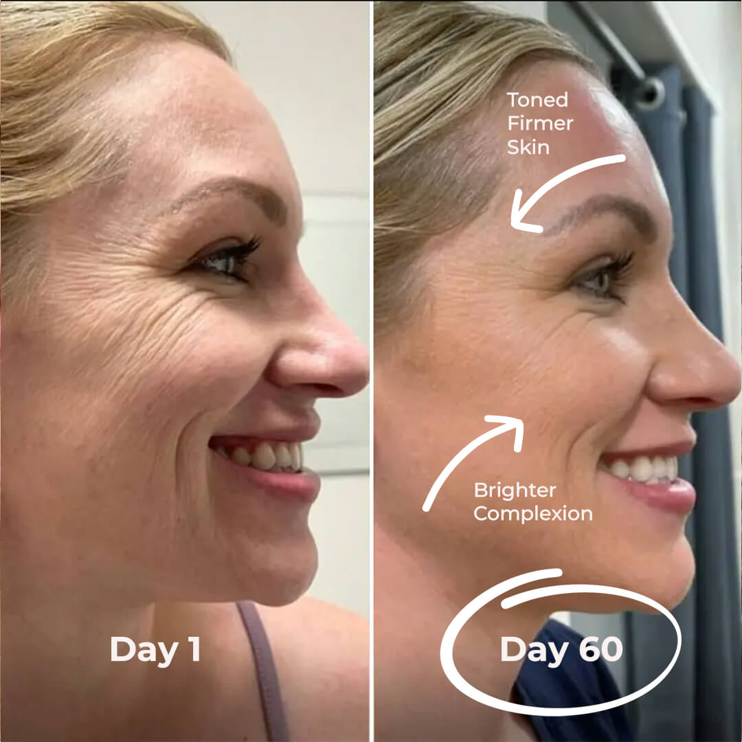 5MinSkin MikroSculpt + Hyaluronsäure Serum (30 Tage Vorrat)