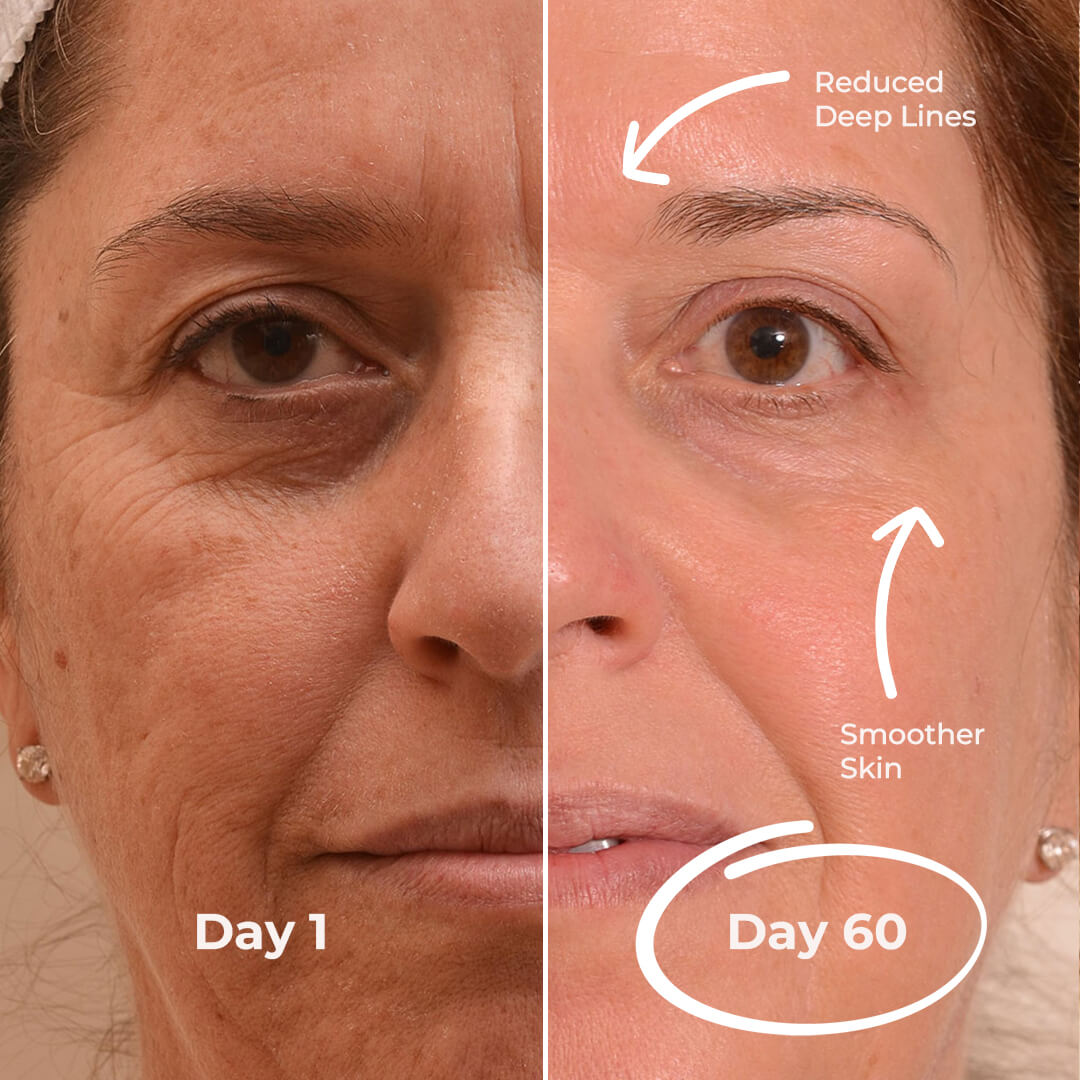 5MinSkin MikroSculpt + Hyaluronsäure Serum (30 Tage Vorrat)