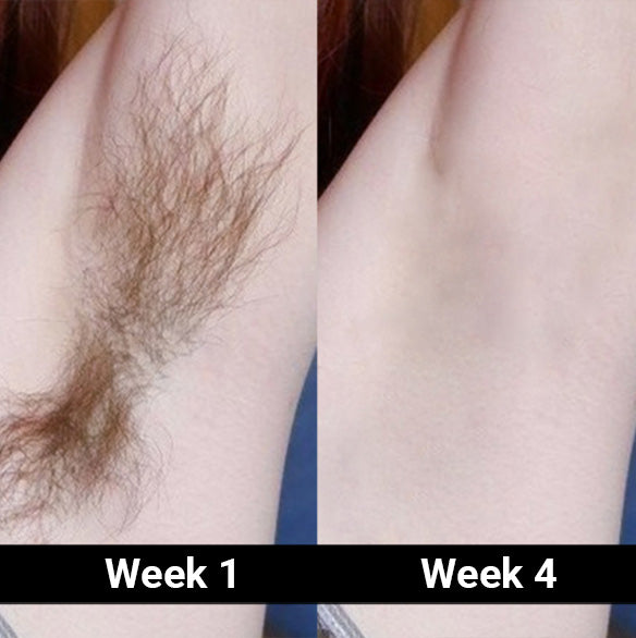 Alvina 💎 on Instagram: #sponsored #5minskin 5MINSKIN HAIR ZAPPER 2.0 -  AT-HOME LASER HAIR REMOVAL HANDSET 🪷Permanent Hair Removal: Start seeing  results in 2- 3 weeks and permanent hair removal in 6-8